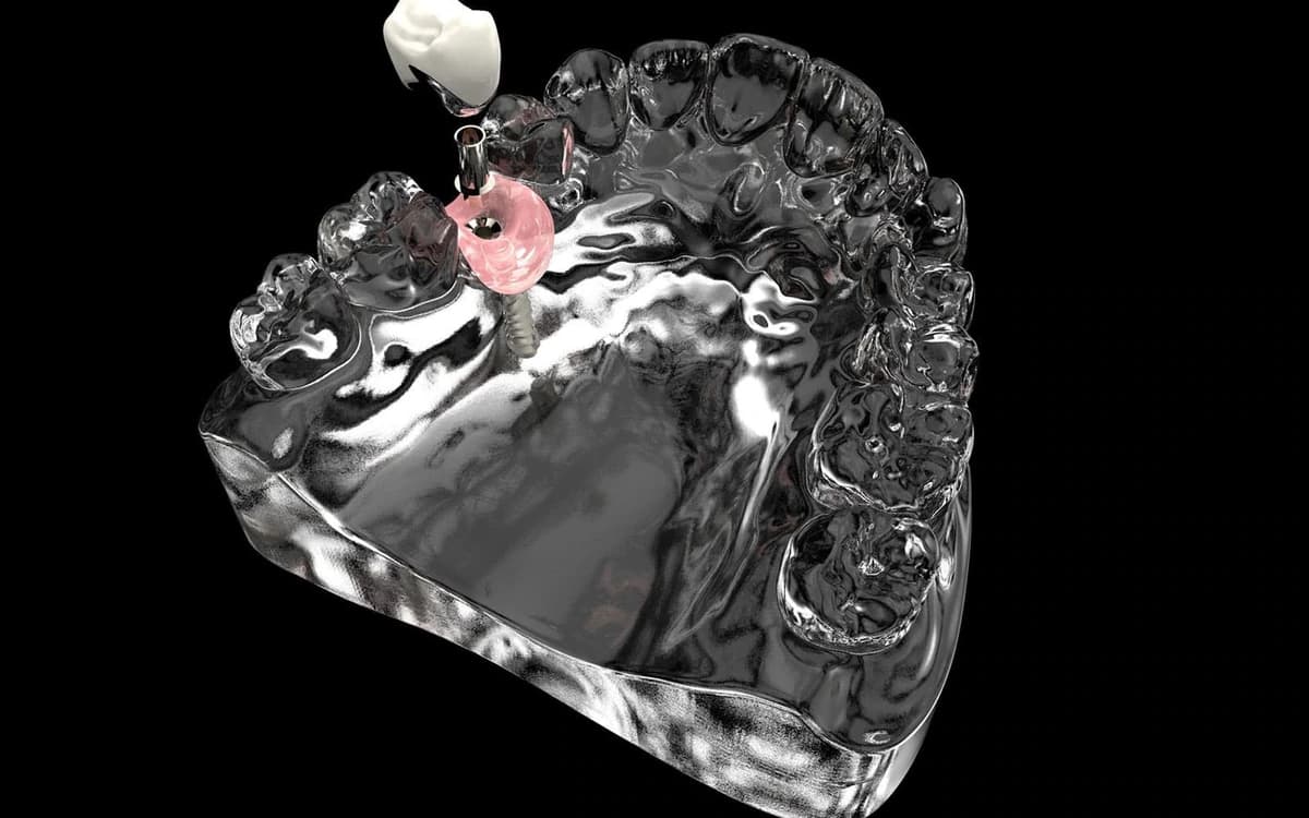 Dental İmplant Tedavisi: Süreç, İyileşme ve Ömür Boyu Kullanım Rehberi