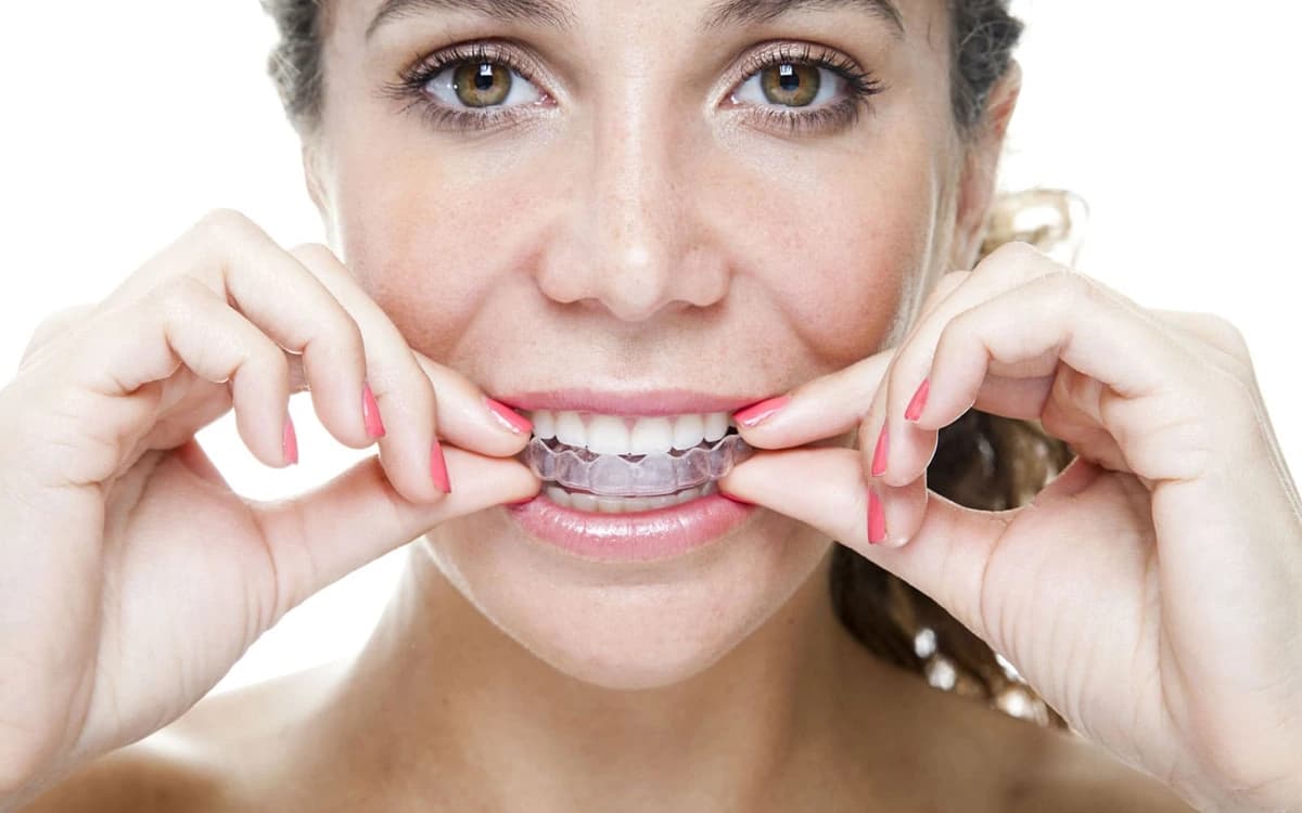 Şeffaf Plak (Invisalign) mı, Geleneksel Diş Teli mi? Hangisi Size Uygun?