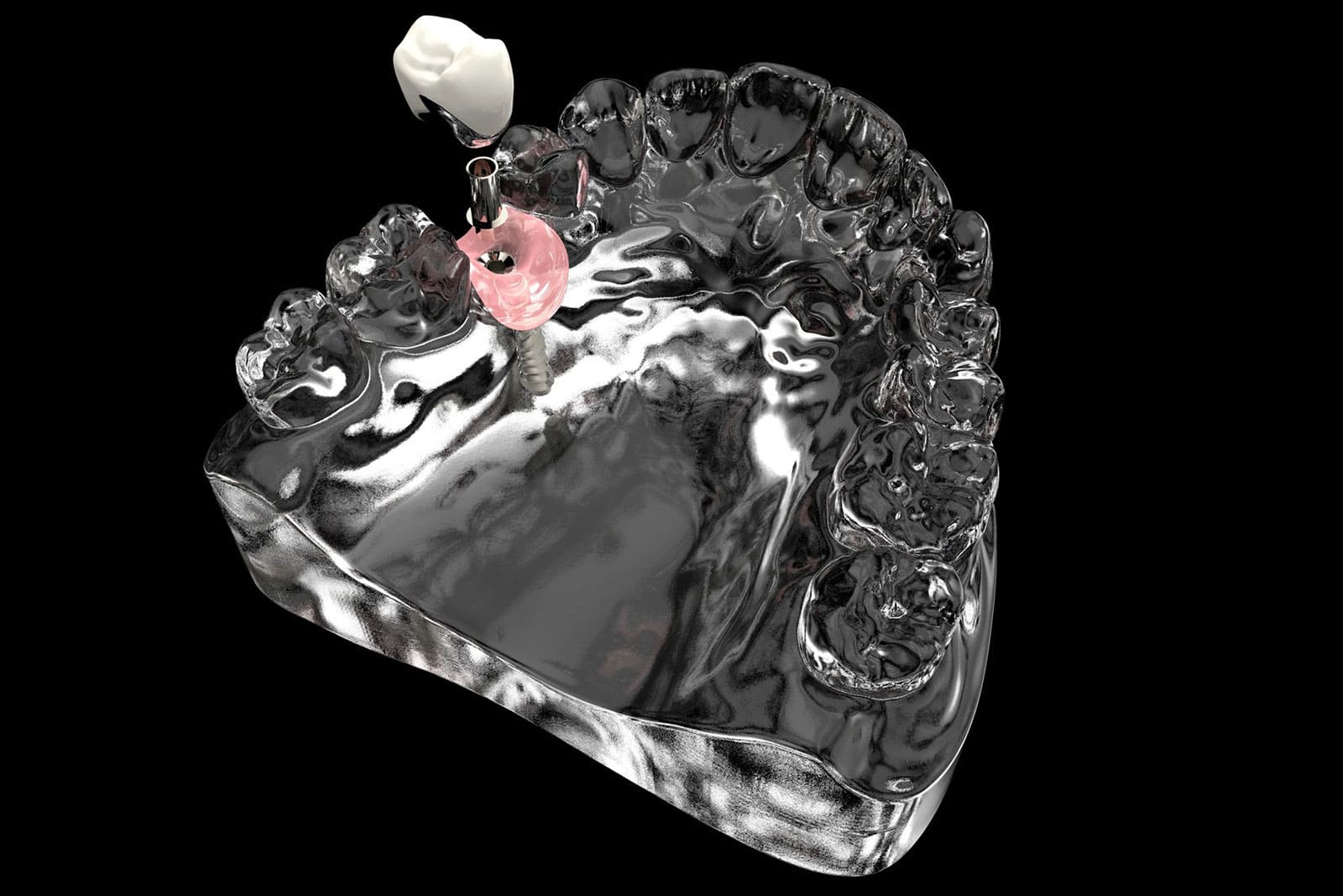 Dental İmplant Tedavisi