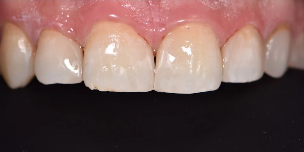 Ön Diş Ayrıklığı (Diastema) Estetik Lamina Tedavisi Sonrası