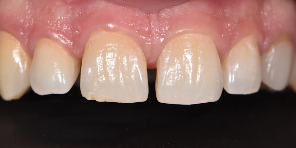 Ön Diş Ayrıklığı (Diastema) Estetik Lamina Tedavisi Öncesi