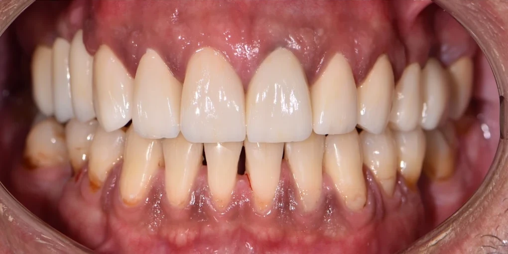 Komple Üst Çene Estetik Köprü ve Gülüş Tasarımı Sonrası