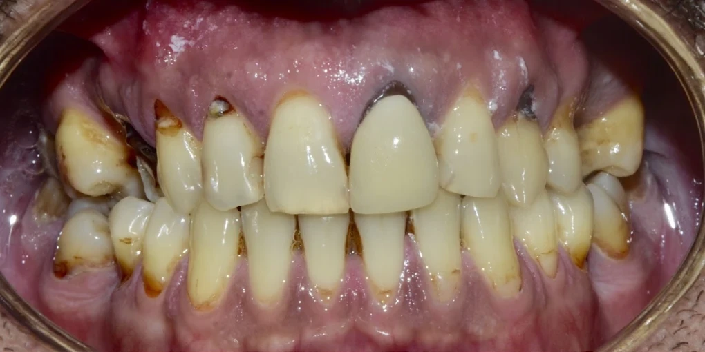 Komple Üst Çene Estetik Köprü ve Gülüş Tasarımı Öncesi
